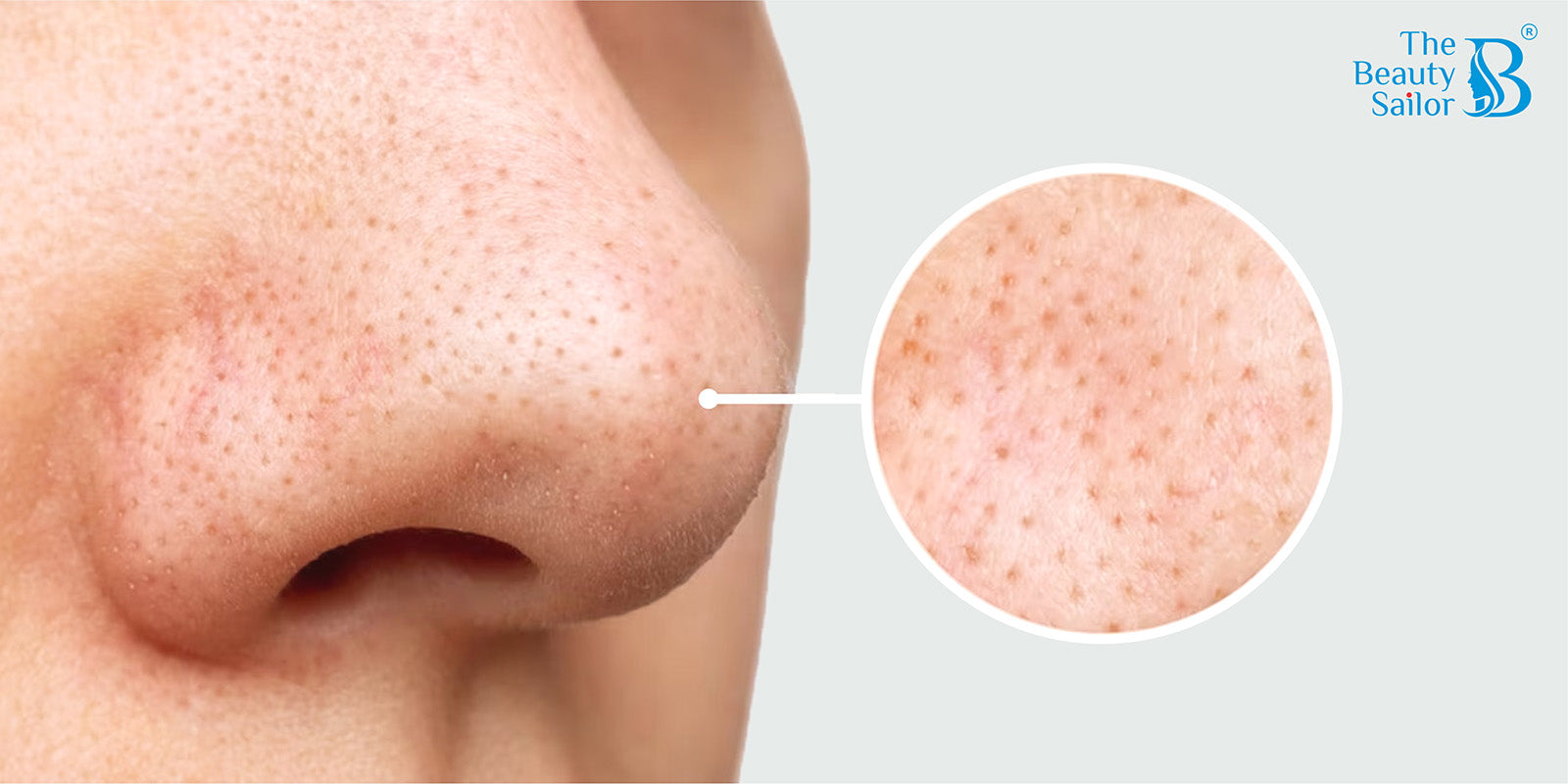 Remove Blackheads And Whiteheads On Nose: Expert Tips